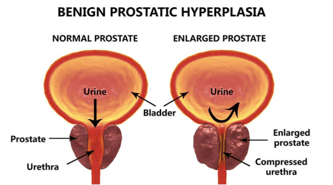 prostastream 